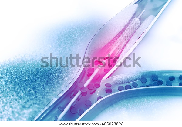 Stent Angioplasty Procedure Placing Balloon Stock Illustration ...