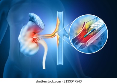 Stent Angioplasty. Renal Artery Disease. Atherosclerosis Progression At The End Blocked Blood Flow. Diseased Kidney. 3d Illustration