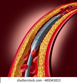 Stent Coronary Placement As An Angioplasty Medical Implant Concept As A Heart Disease Treatment Symbol With An Implant In An Artery That Has Cholesterol Plaque Blockage As A 3D Illustration.