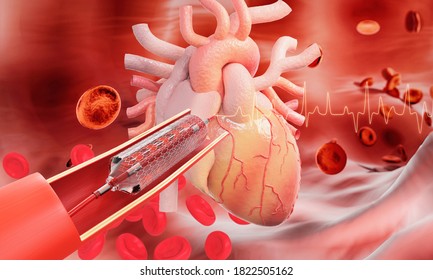 Stent implantation for heart coronary with blood cell background.  3d render.
