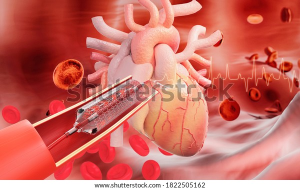 Stent implantation for heart coronary with blood\
cell background.  3d\
render.