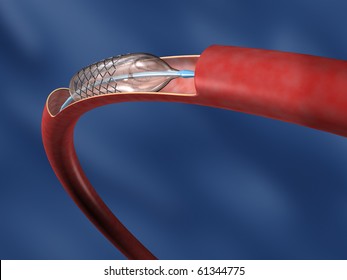 Stent On Balloon In Curved Artery