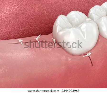 Stitches on gum after wisdom tooth extraction. 3D illustration of dental treatment Foto stock © 