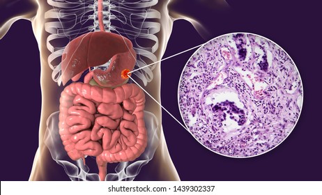 Stomach Adenocarcinoma, Gastric Cancer, 3D Illustration And Light Micrograph