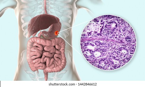 Stomach Adenocarcinoma, Gastric Cancer, 3D Illustration And Light Micrograph