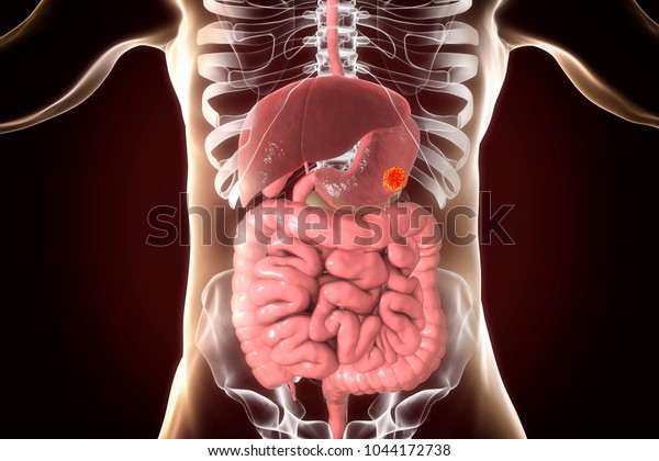 胃がん ヒトの消化器系の解剖学と胃内の腫瘍を示す3dイラスト のイラスト素材
