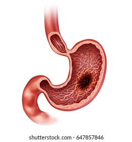 Stomach Cancer Concept As A Gastric Disease With Malignant Tumor Growth In The Digestive System As A Medical And Gastrointestinal Medicine With 3D Illustration Elements.