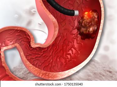 Stomach Cancer, Gastric Cancer, Cancer Treatment. 3d Illustration		