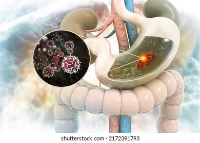 Stomach Cancer, Symptoms, Stages, Treatment, 3d Illustration