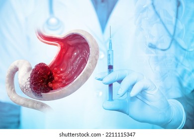 Stomach Cancer Treatment Concept. Stages Of Development Of A Malignant Tumour Or Cancer Of The Stomach. Cancer Therapy, Injection. 3d Illustration