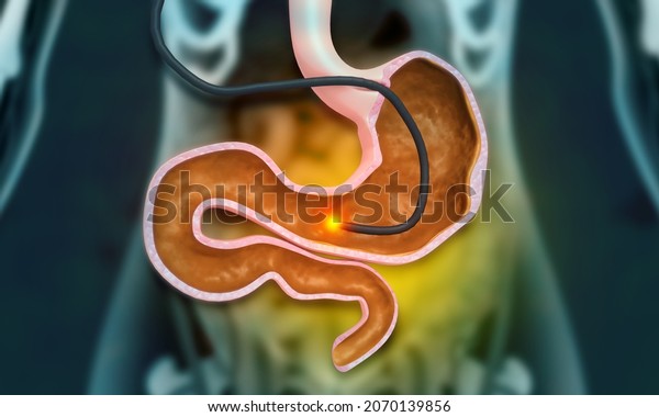 Stomach Endoscopy Gastric Ballon Inside Stomach Stock Illustration ...