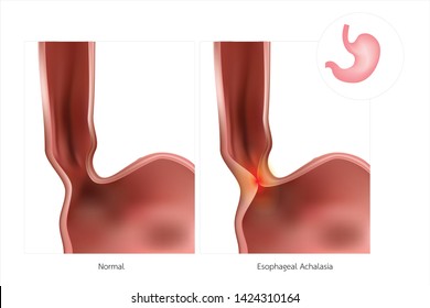 The Stomach Or Esophagus Is Often Referred To As Simple Achalasia. The Lower Esophageal Sphincter Does Not Relax, Causing Inflammation.