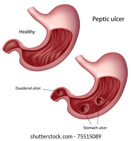 Stomach Ulcer