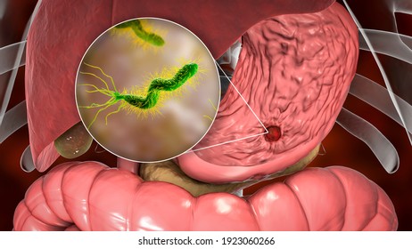 Stomach Ulcer And Closeup View Of Bacteria Helicobacter Pylori, Associated With Ulcer Formation, 3D Illustration