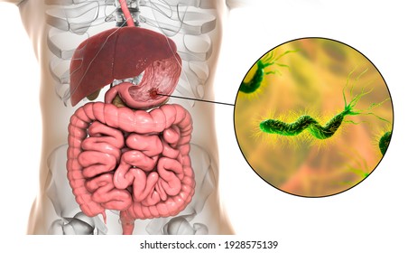 Stomach Ulcer And Closeup View Of Bacteria Helicobacter Pylori, Associated With Ulcer Formation, 3D Illustration