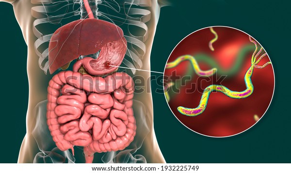 Stomach ulcer and\
closeup view of bacteria Helicobacter pylori, associated with ulcer\
formation, 3D\
illustration