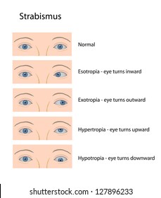 Strabismus