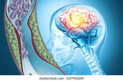 Stroke. A Blood Clot In The Vessels Of The Human Brain. Human Anatomy Disease. Acute Impairment Of Cerebral Circulation. 3d Illustration