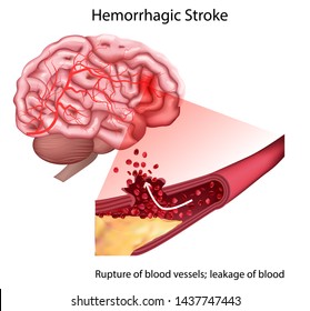 77,459 Types of stroke Images, Stock Photos & Vectors | Shutterstock