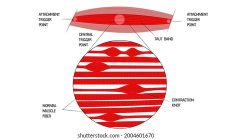 The Structure Of The Trigger Point In The Muscle. Attachment Trigger Point. Taut Band. Contraction Knot. Normal Muscle Fiber. Illustration, Isolate On A White Background.