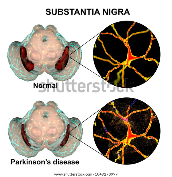 Substantia Nigra Norm Parkinsons Disease 3d Stock