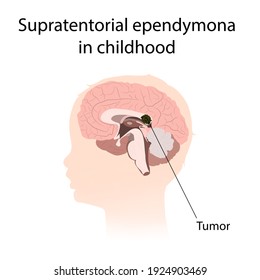Supratentorial ependymona in childhood. Brain cancer, tumor with explanations.