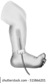 Surgical Drain - Child's Lower Leg And Foot