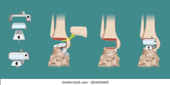 Surgical Intervention Of Orthopedics Prosthesis Of The Ankle - Arthroplasty. 