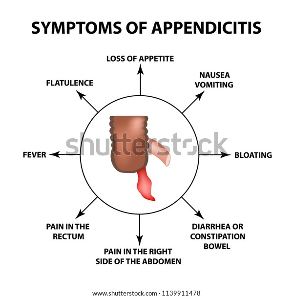 Symptoms Appendicitis Inflammation Appendix Infographics Illustration ...