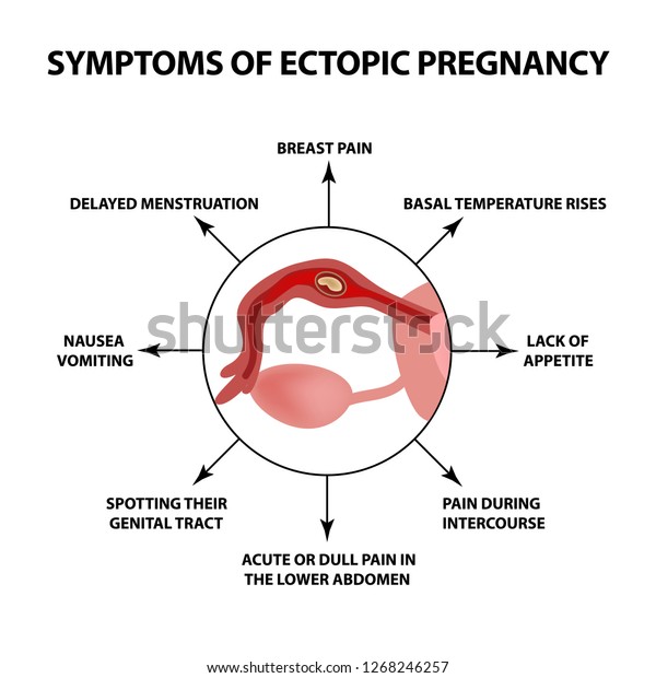 Symptoms Ectopic Pregnancy Infographics Illustration On Stock