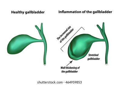Symptoms Gallbladder Inflammation Cholecystitis Thickening Gallbladder ...