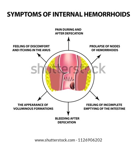 Symptoms of internal hemorrhoids. The hemorrhoidal node in the rectum, anus. Infographics. illustration on isolated background