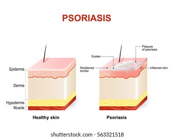 Symptoms Of Psoriasis. Normal Skin And Psoriasis. Plaque Psoriasis