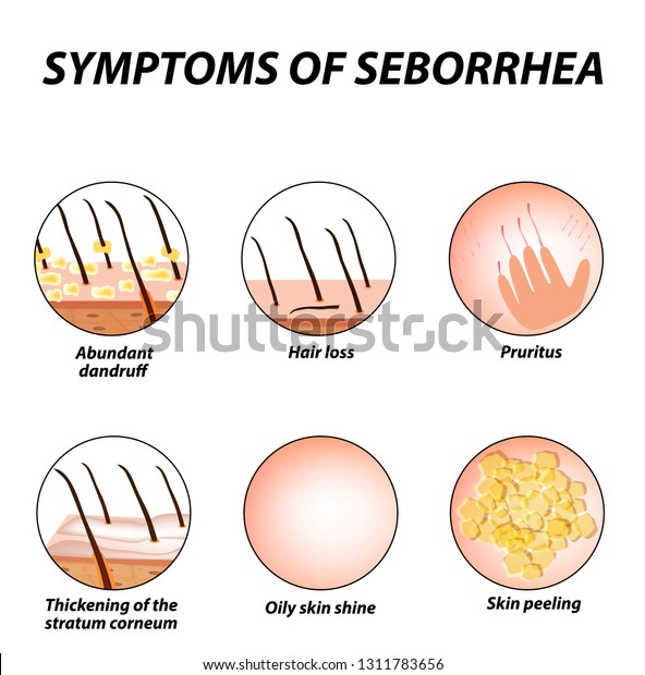 Symptoms Seborrhea Seborrhea Skin Hair Dandruff Stock Illustration