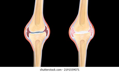 Synovial Fluid In Joints Osteoarthritis Degenerative Joint Disease Anatomy 3d Illustration