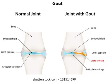 Synovial Joint with Gout