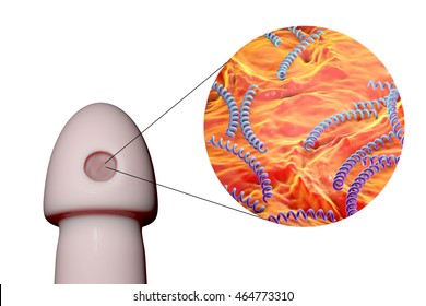 Syphilitic Ulcer Ulcus Durum And Close-up View Of Syphilis Bacteria Treponema Pallidum On The Surface Of A Penis, 3D Illustration