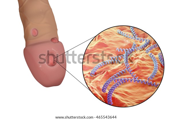 Syphilitic Ulcers Ulcus Durum Closeup View Stock Illustration 465543644