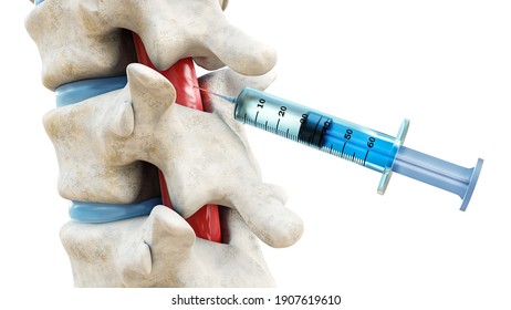 Syringe in the spinal cord isolated on a white background. Backbone or spinal column treatment with epidural injection 3D rendering illustration. Medical and healthcare, anatomy, medicine concept.