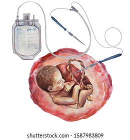 Taking Umbilical Cord Blood, Stem Cells From An Infant.  Blood Sampling Bag.  Baby In The Womb.  Watercolor Illustration On A White Background.