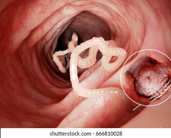 Tapeworm in human intestine, magnification of the head attached to the intestine.3D rendering.
Tapeworms are a species of parasitic flatworms. They live in the digestive tracts of vertebrates.