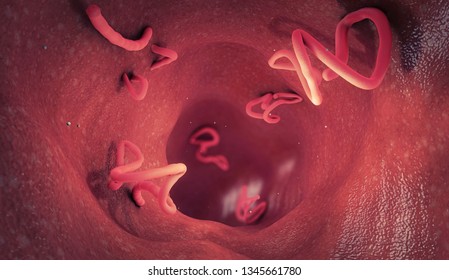 Tapeworm infestation in a human intestine - 3d illustration