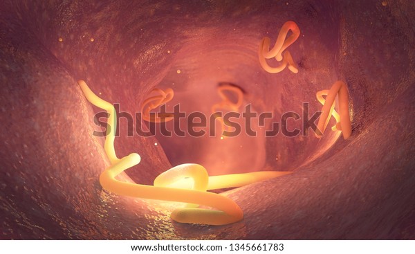 Tapeworm infestation in a human intestine -\
3d illustration