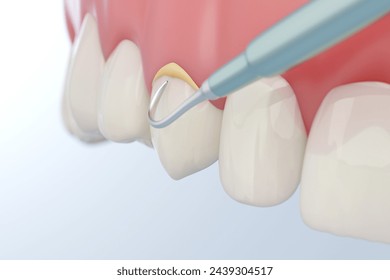 tartar removal tool removing dental calculus sticking on teeth and gums. 3D rendering. - Powered by Shutterstock