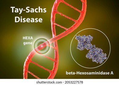 Tay-Sachs Disease, 3D Illustration. A Genetic Disorder That Progressively Destroys Brain Neurons, Is Caused By A Genetic Mutation In The HEXA Gene Leading To Deficiency Of Hexosaminidase A Enzyme