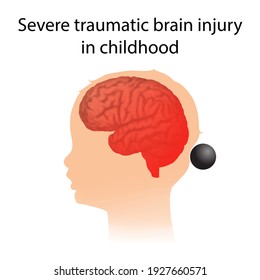 TBI. Severe Traumatic Brain Injury In Childhood. Kid, Child Head Damage.