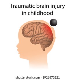 TBI. Traumatic Brain Injury In Childhood. Kid, Child Head Damage.