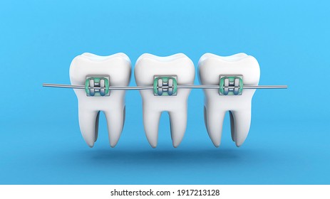 Teeth braces. Teeth alignment. Three white teeth with braces on a blue background. 3d render.