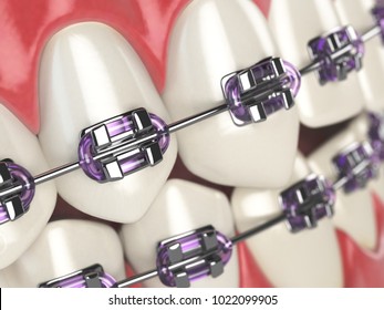 Teeth With Braces Or Brackets In Open Human Mouth. Dental Care Concept. 3d Illustration