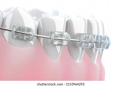 Teeth With Braces Or Brackets In Open Human Mouth. Dental Care. 3D Illustration